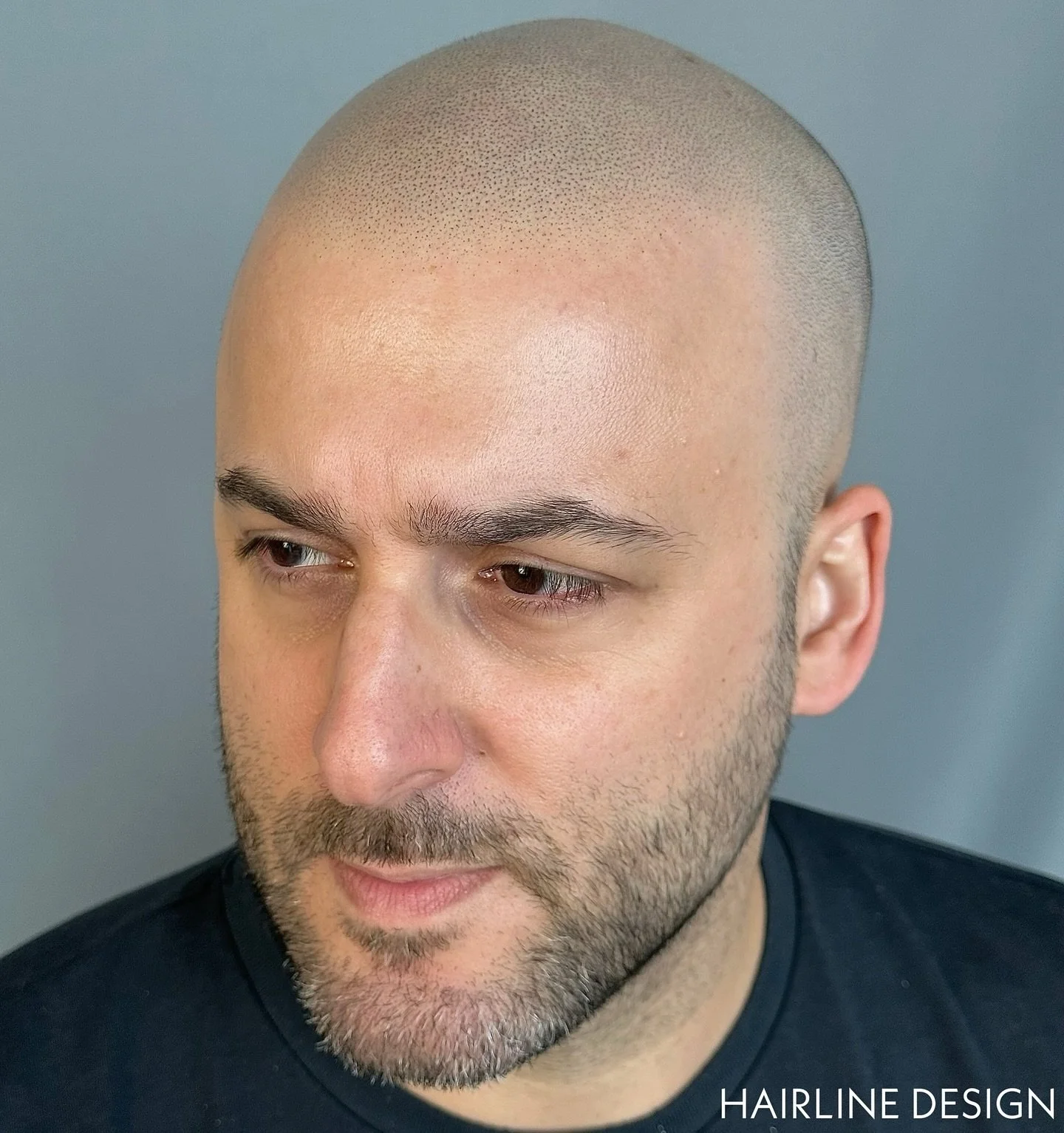 Softy soft!  A very natural take on SMP. Hairlines and SMP density to suit all! The Choice is Yours 🙌🏼 ✔️

www.hairlinedesigndubai.com | +971585679977

Consulations are FREE ✉️

We look forward to seeing you 🤙🏼

#smp #smpdubai #scalpmicropigmenta
