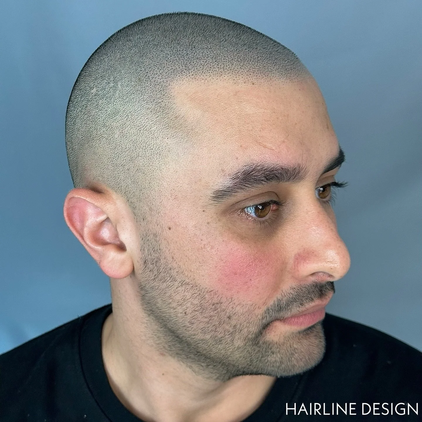 Hairlines go a LONG way 📈 - ⚠️ Keep yours in check ⚠️

Free consultations 📩 Bookings 📞 +971585679977

www.hairlinedesigndubai.com

#smp #smpdubai #scalpmicropigmentationdubai #hairloss #scalpmicropigmentation #hairtransplantdubai #hairlosssolution