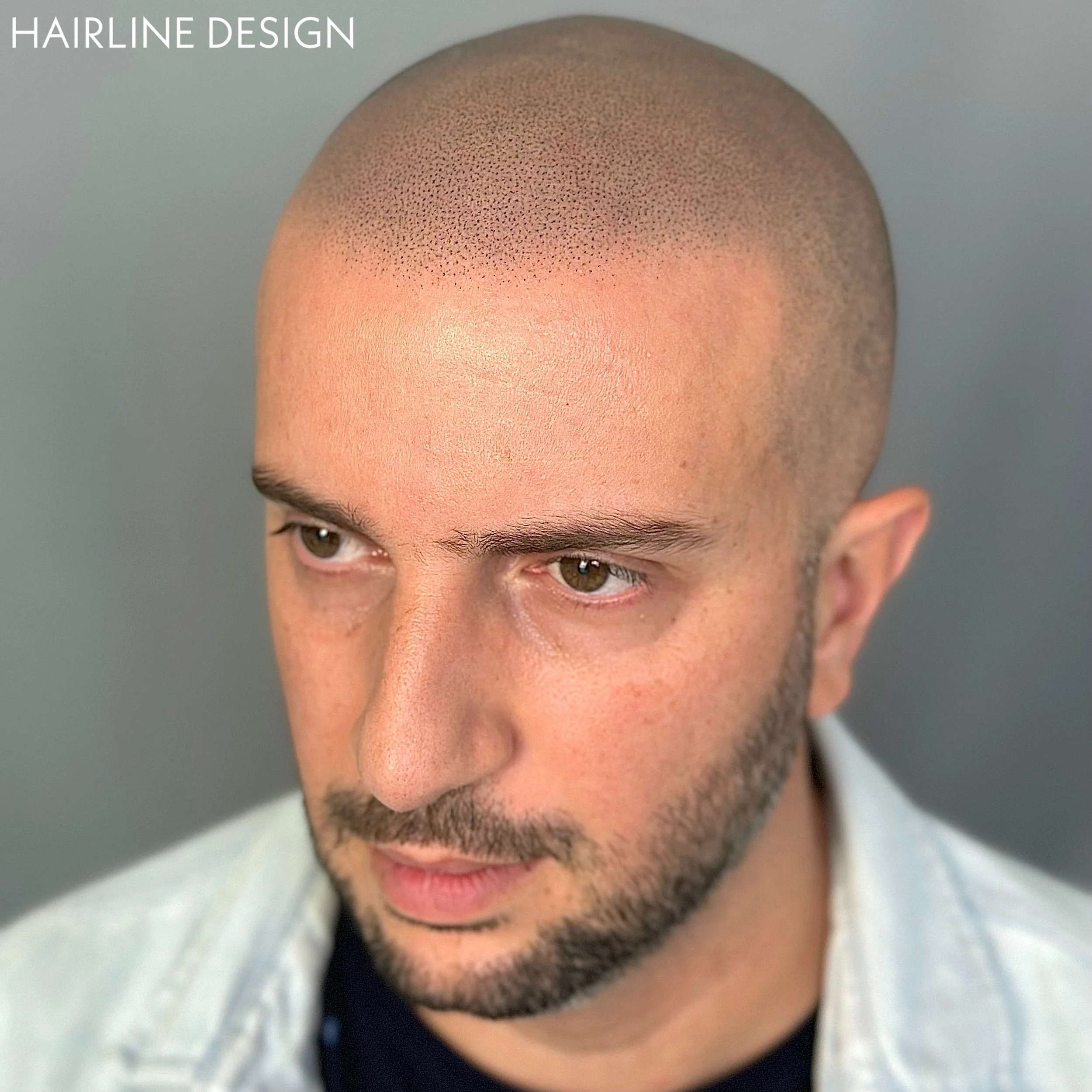 Clean and consistent, simple and natural SMP results. 

Soft and broken natural hairline to compliment the clients features and face shape. 

Simple SMP, don&rsquo;t complicate it 🤝🏼

Free instant video consultations. DM us to schedule an appointme