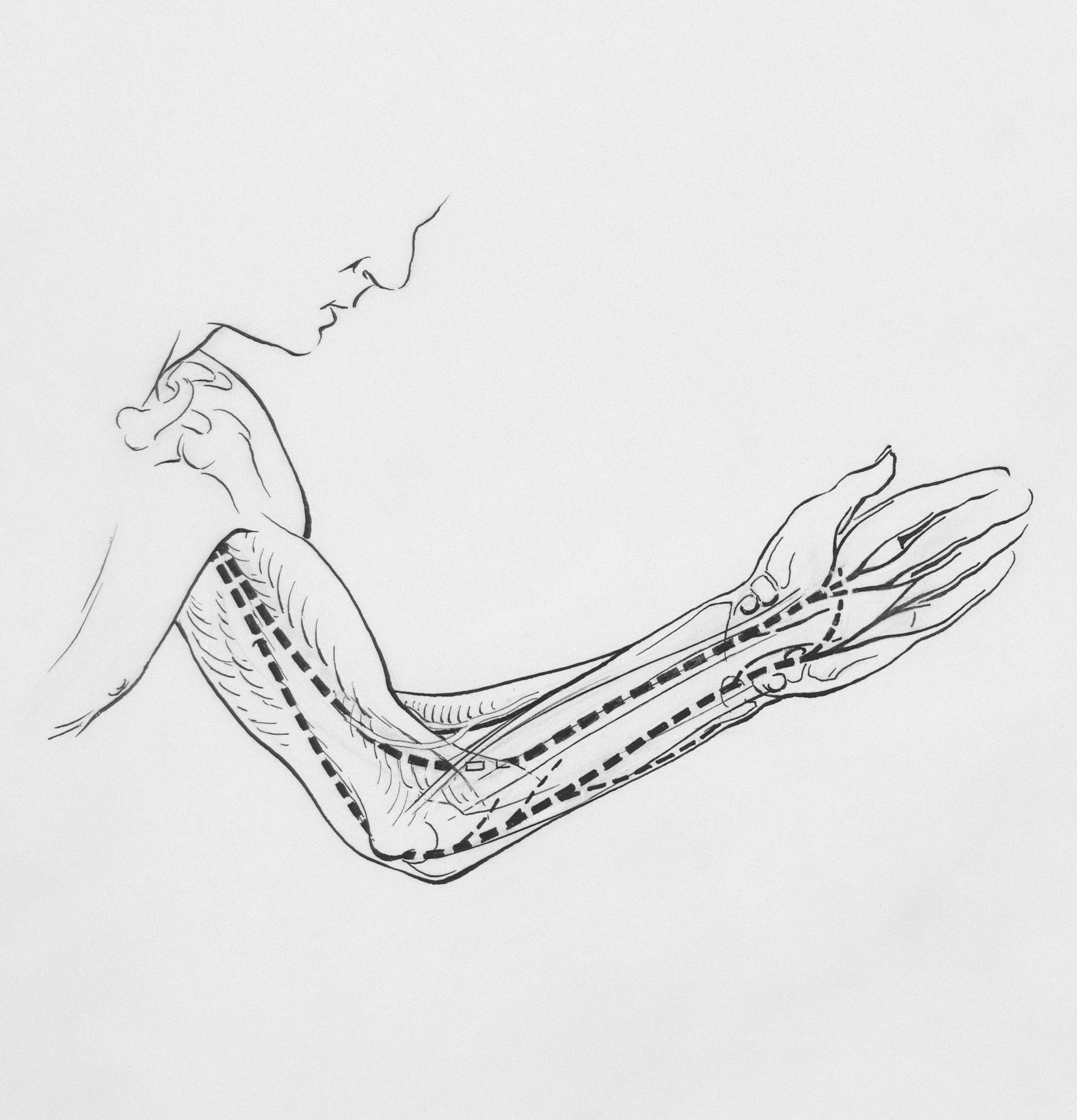 Ulnar Nerve Decompression Explained