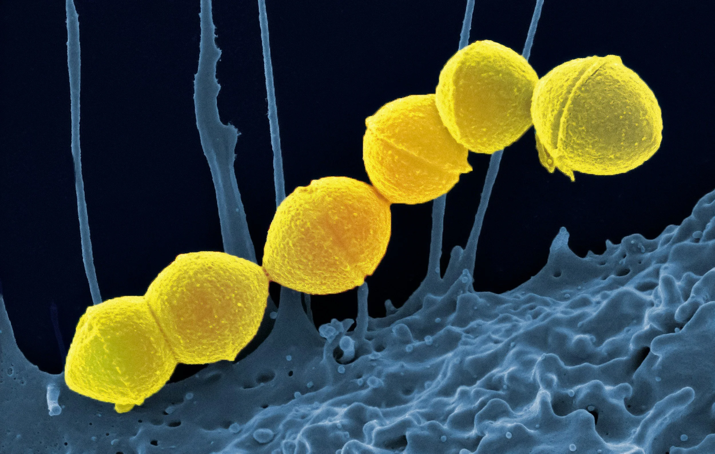 Leaky gut and acid reflux