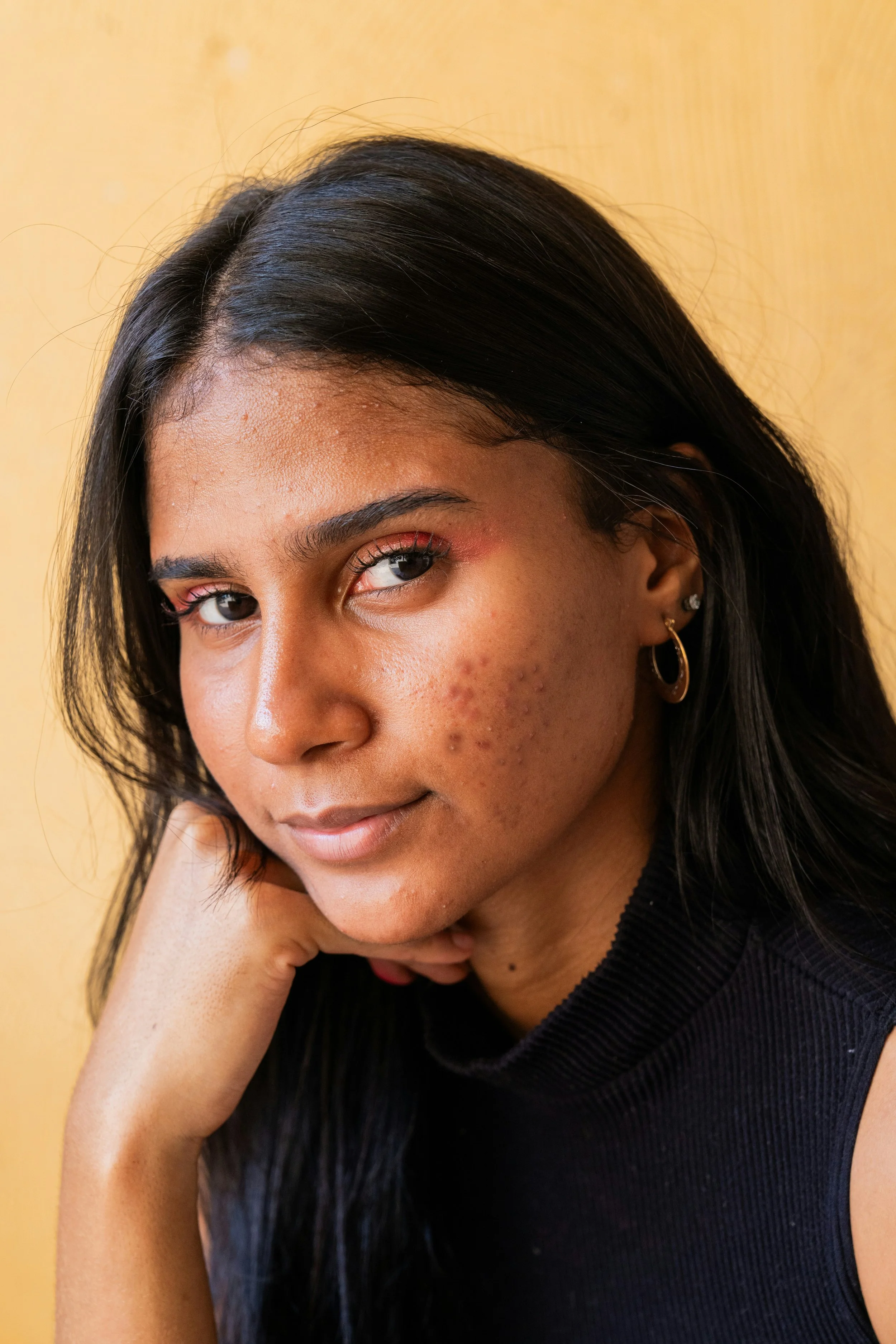 Women with Acne | Insulin can interfere with hormones causing symptoms like acne