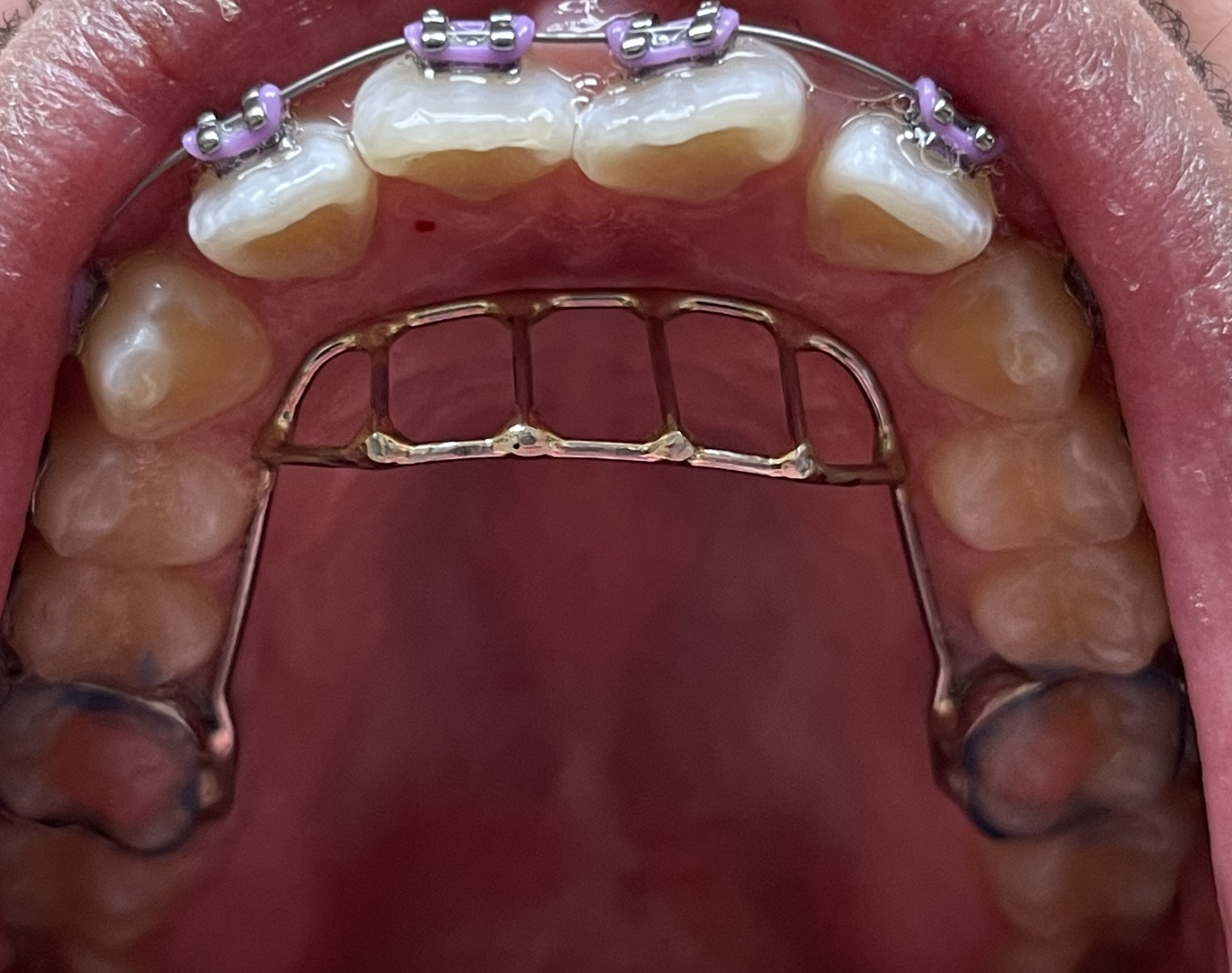 Tratamiento de la interferencia lingual en Los Ángeles