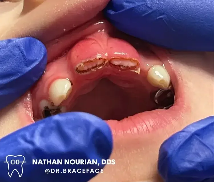 Close-up of a dental examination showing laser on the upper front teeth, with the gums and mouth open, gloves holding the lips.