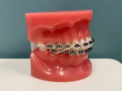 A dental model of teeth with braces and an orthodontic archwire.