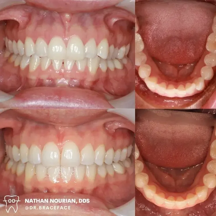 Comparison of teeth before and after dental treatment showing improved alignment and cleanliness of teeth and gums.