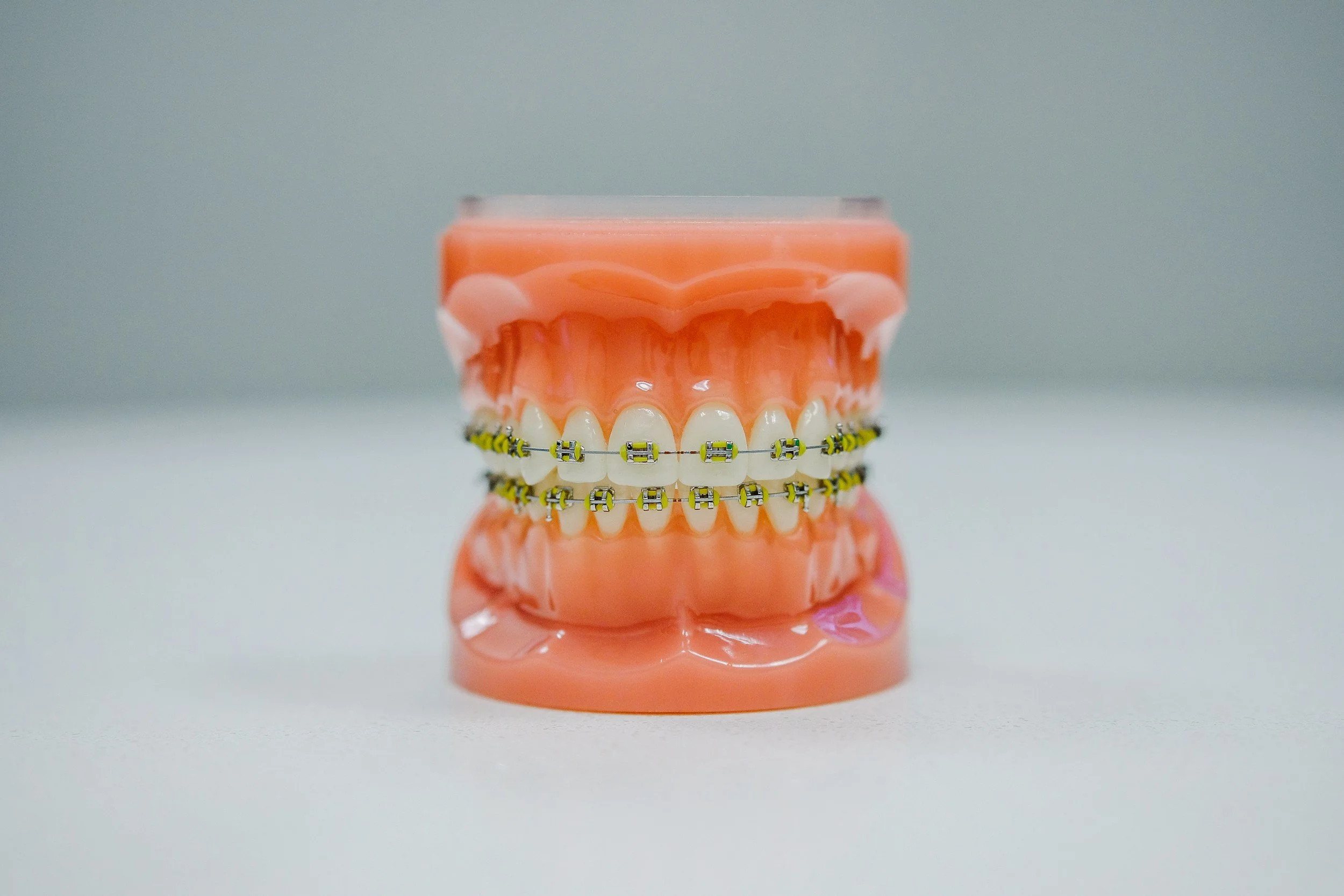 A dental model with upper and lower teeth fitted with braces.