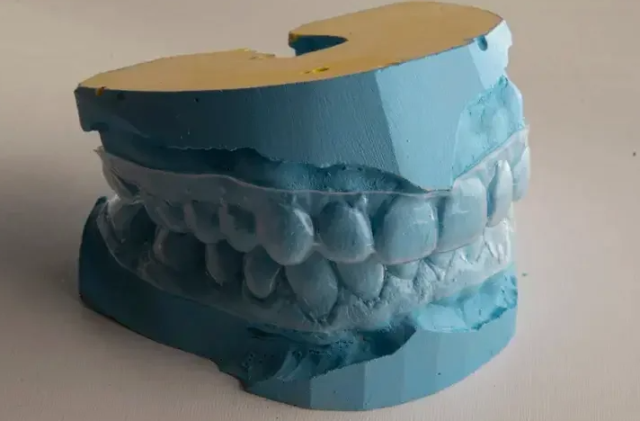 How Tight Should a Dental Retainer Feel?