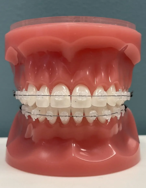 Do Ceramic Braces Stain Easily? How to Prevent Discoloration