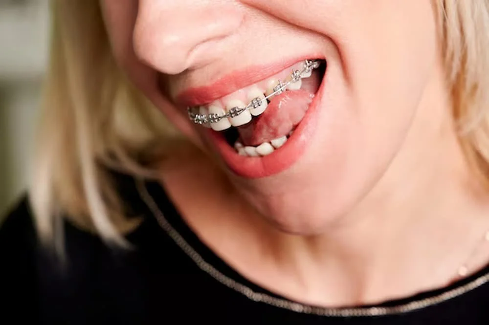 How Metal Braces Work to Straighten Teeth
