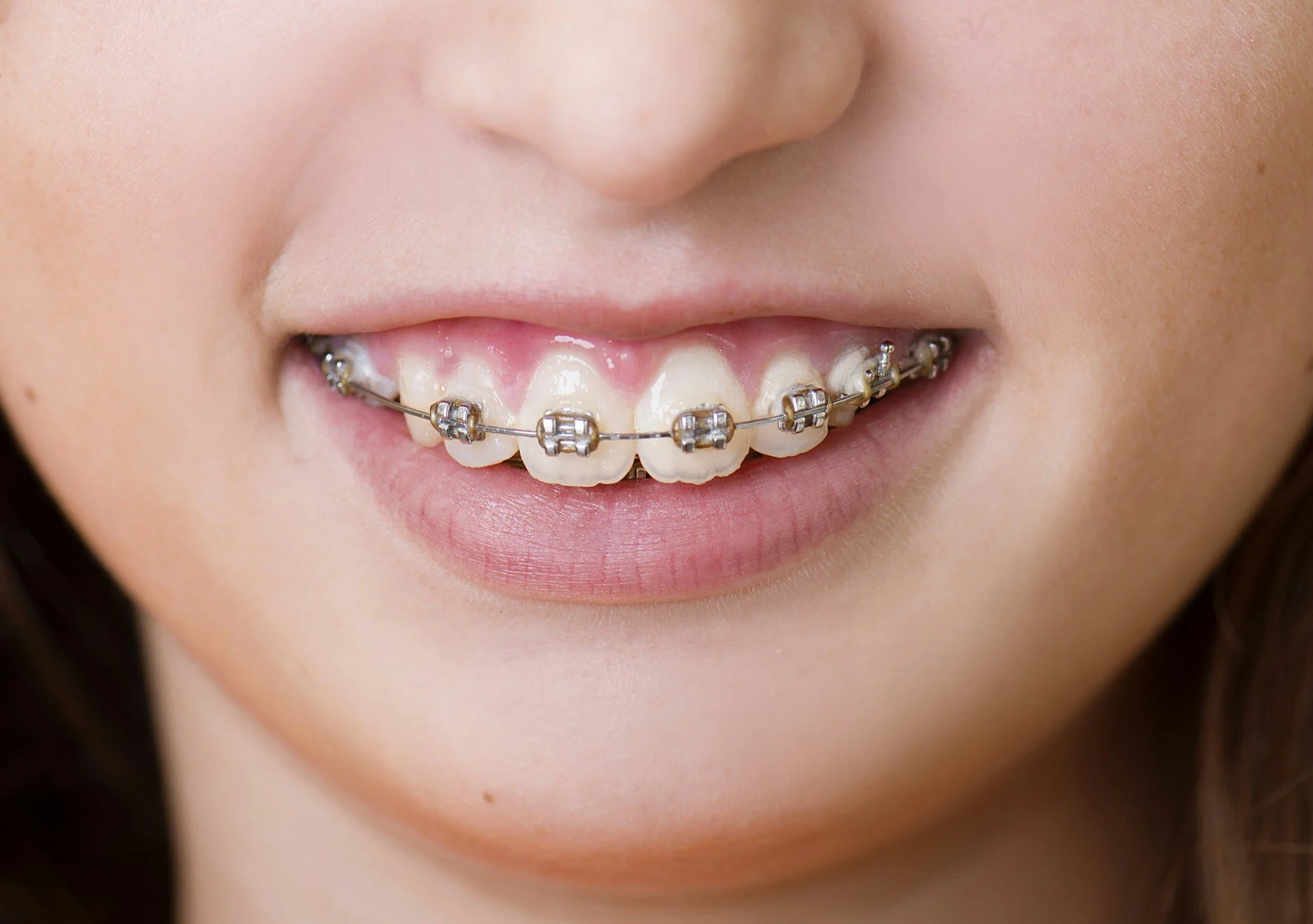 What Happens If You Break a Ceramic Bracket? Here's What to Do