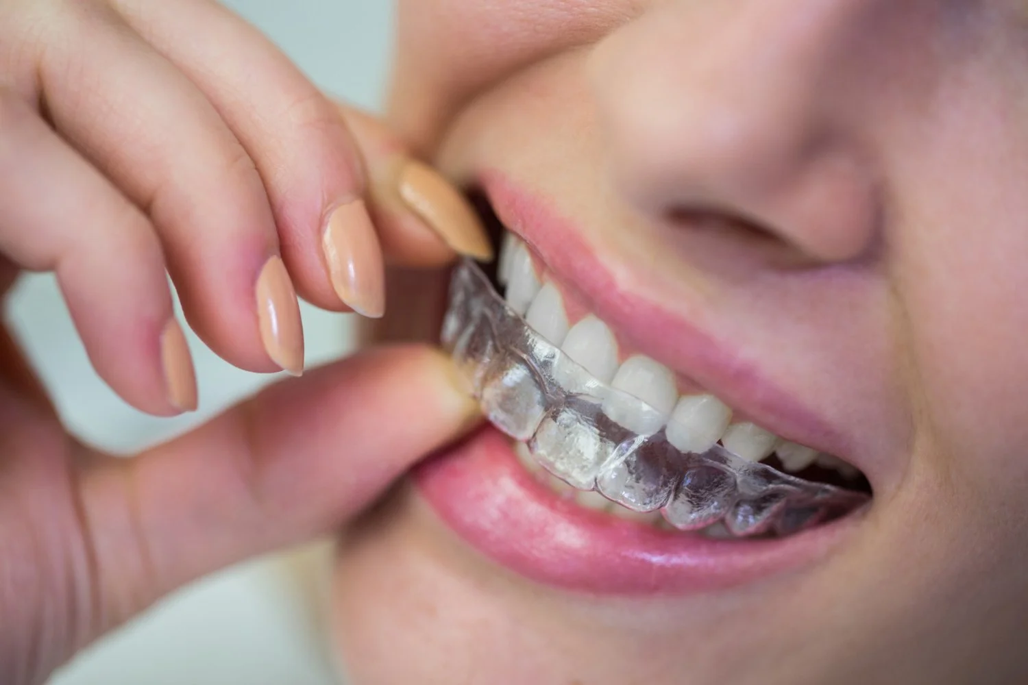 What Happens at Your First Invisalign Consultation?