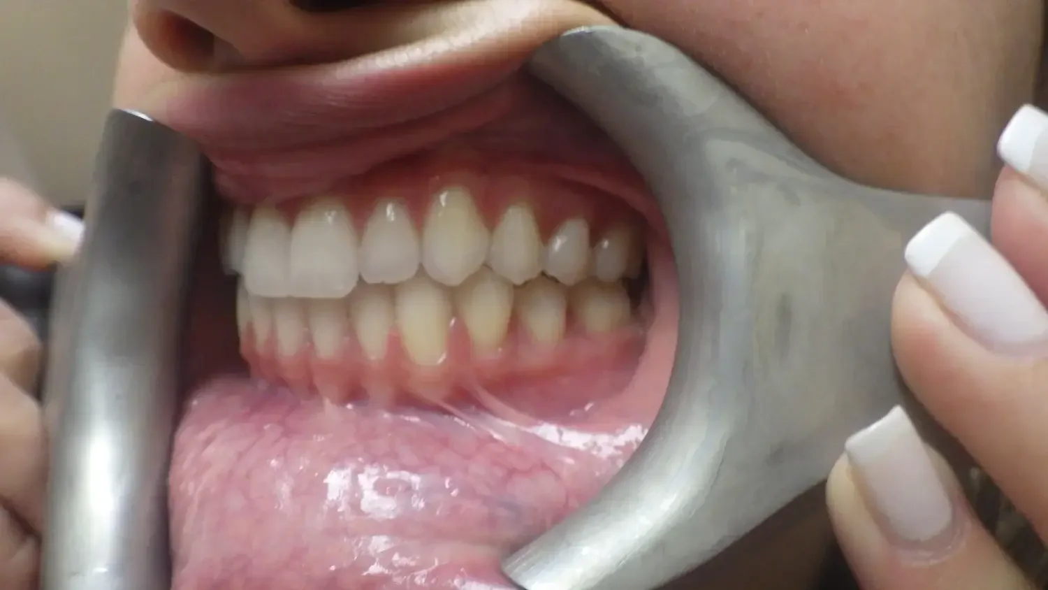 A person's open mouth held open with a dental retractor, showing upper and lower teeth, gums, and tongue.