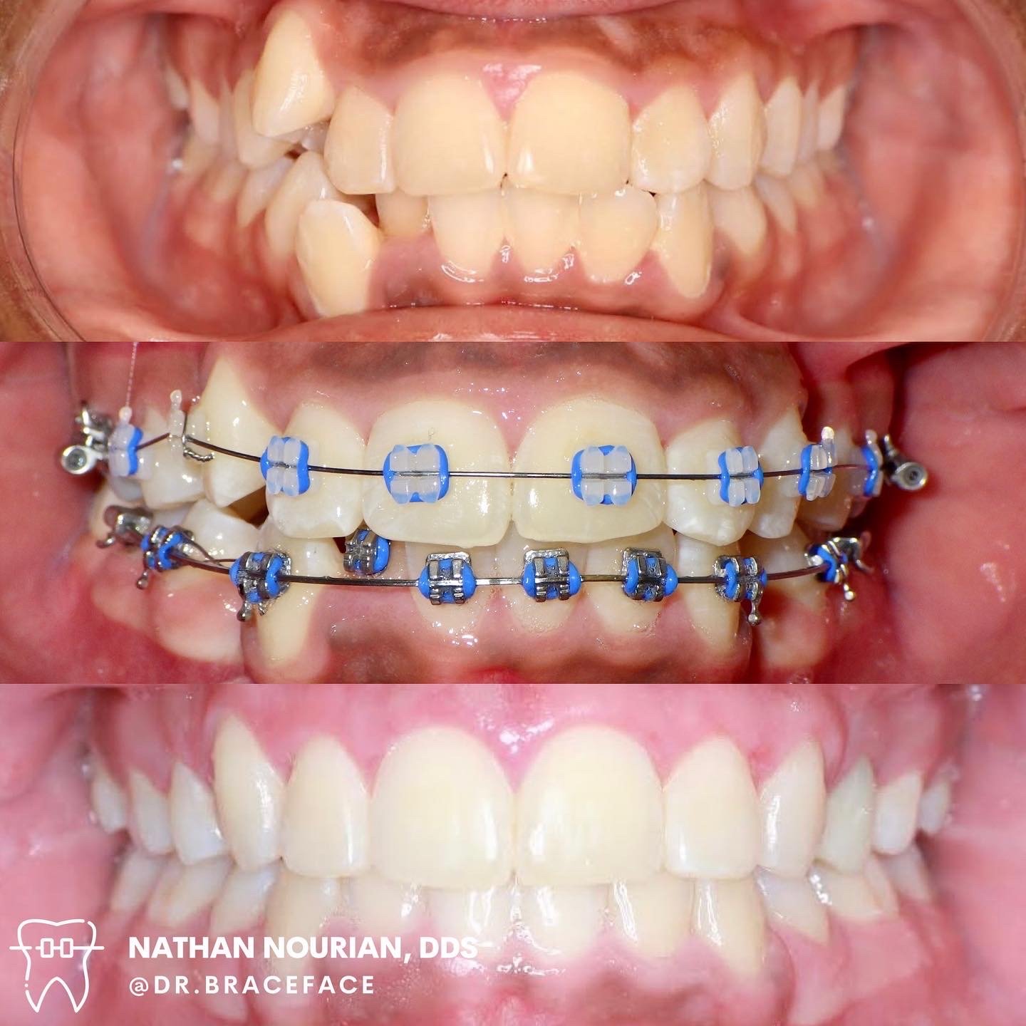 Ceramic Braces in Los Angeles  The Orthospaceship- Hakim Orthodontics