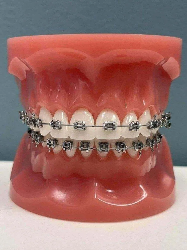 Braces in van nuys