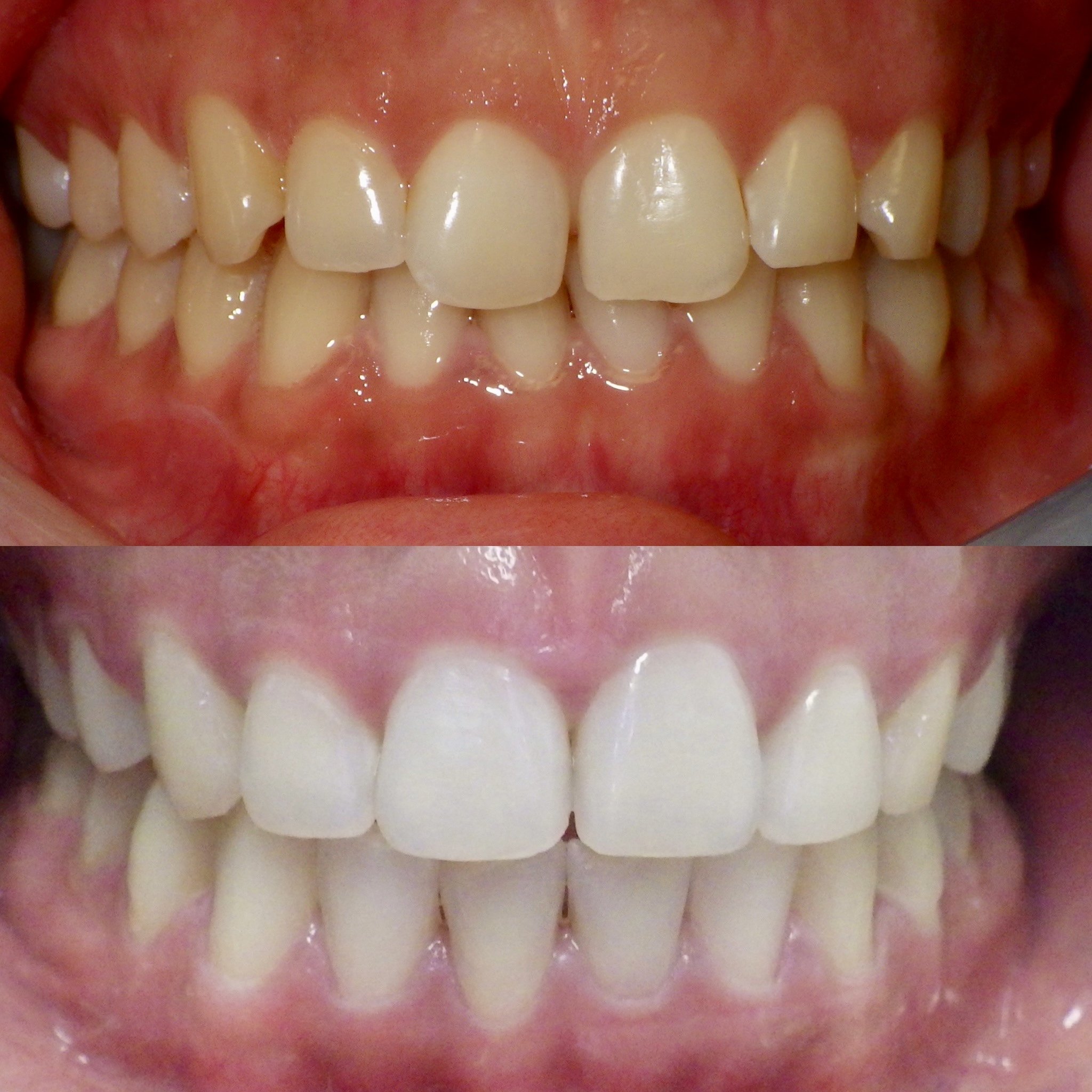braces teeth straightening in Los angeles