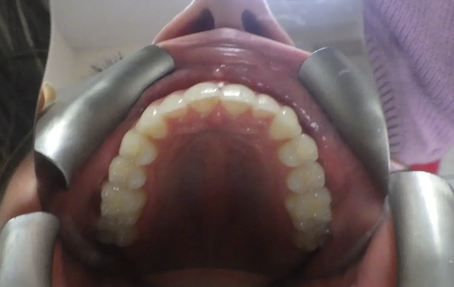 Close-up of a person's open mouth showing teeth, gums, and palate, with dental retractors holding the lips apart.