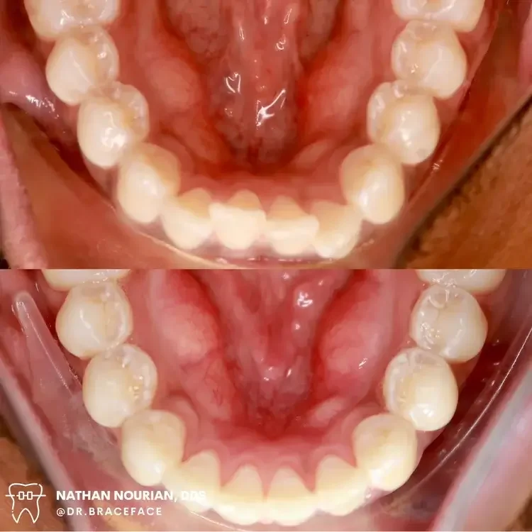Comparison of dental arches before and after orthodontic treatment, showing alignment improvement.