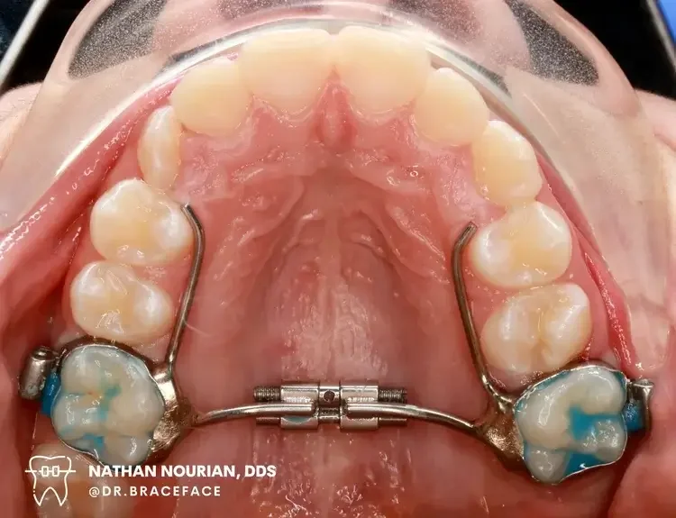 View of the upper dental arch with orthodontic appliances, including metal brackets and wires, and blue-colored dental marking material on molars.