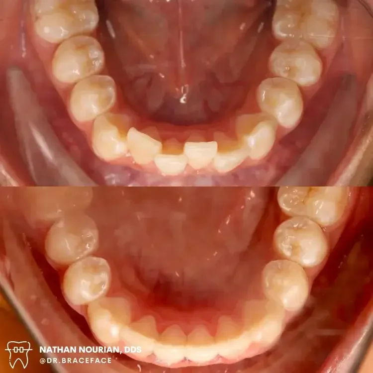 Comparison of lower teeth before and after dental treatment, showing improved alignment after orthodontic work.