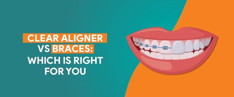 Clear Aligners vs Braces: Which is Right for You?