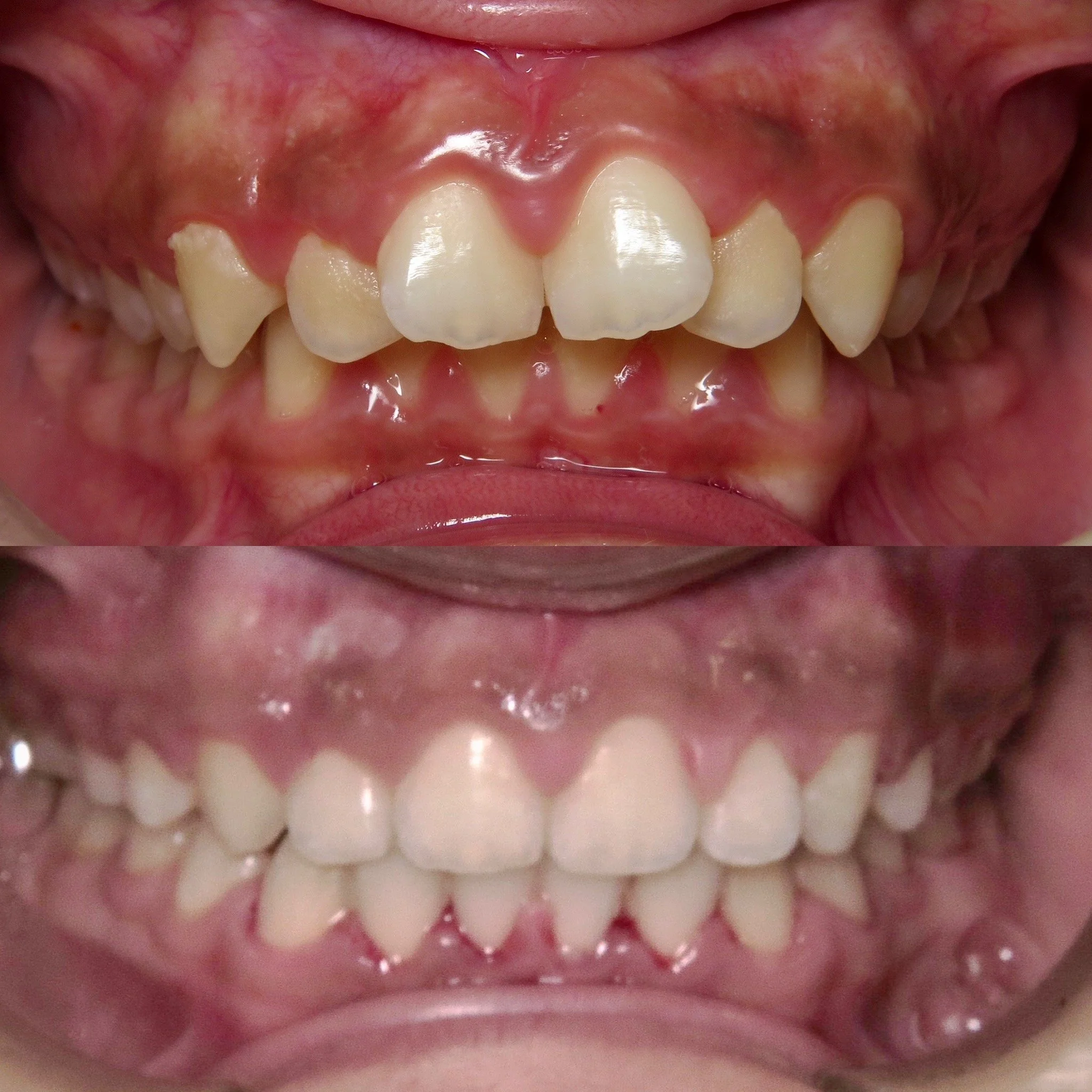 Comparison of teeth before and after dental treatment, showing improved alignment and appearance.
