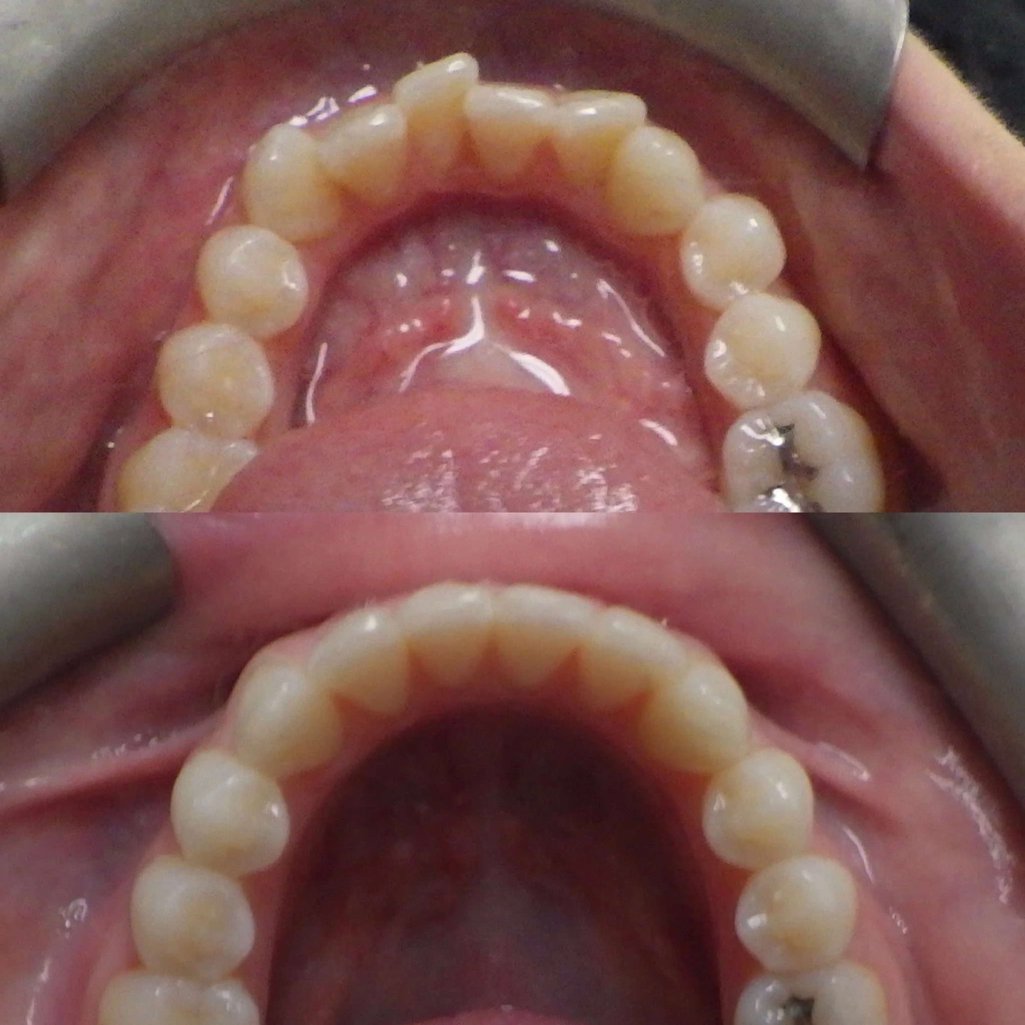 lower crowding corrected with braces