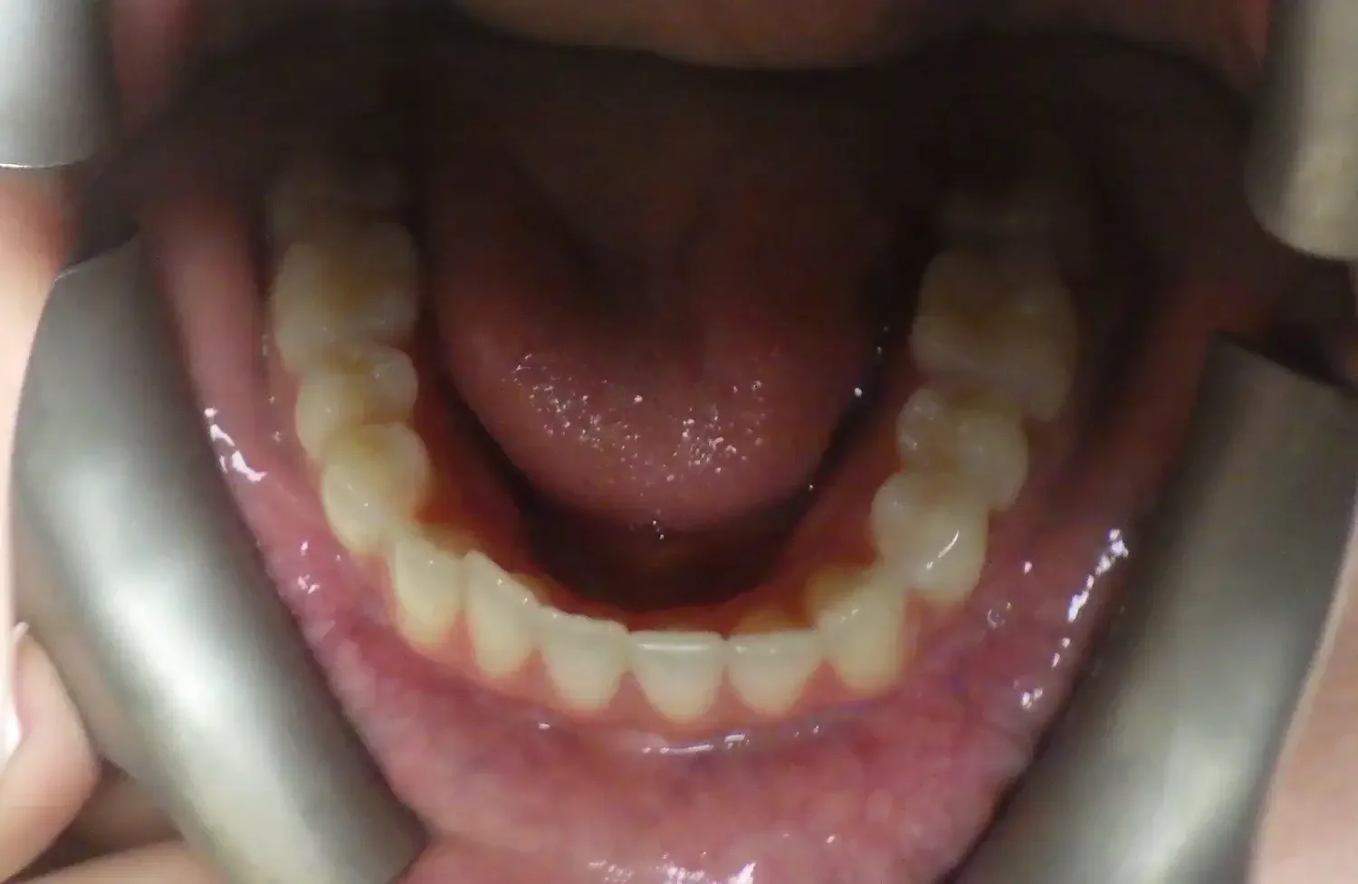 Close-up of an open mouth showing upper and lower teeth and tongue.