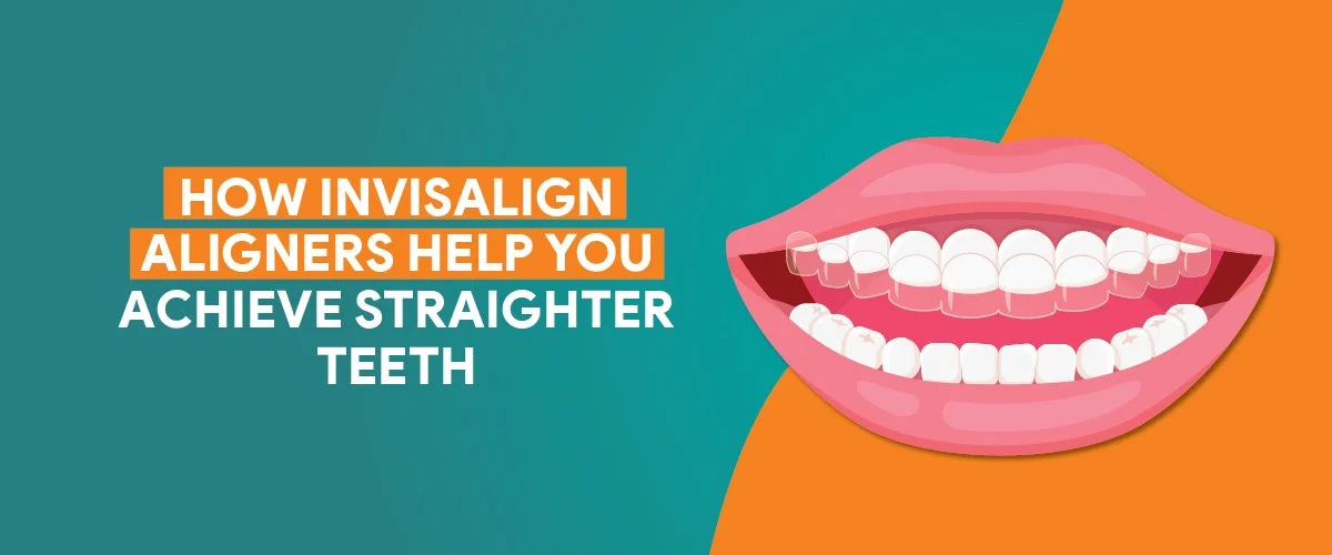 Invisalign Aligners