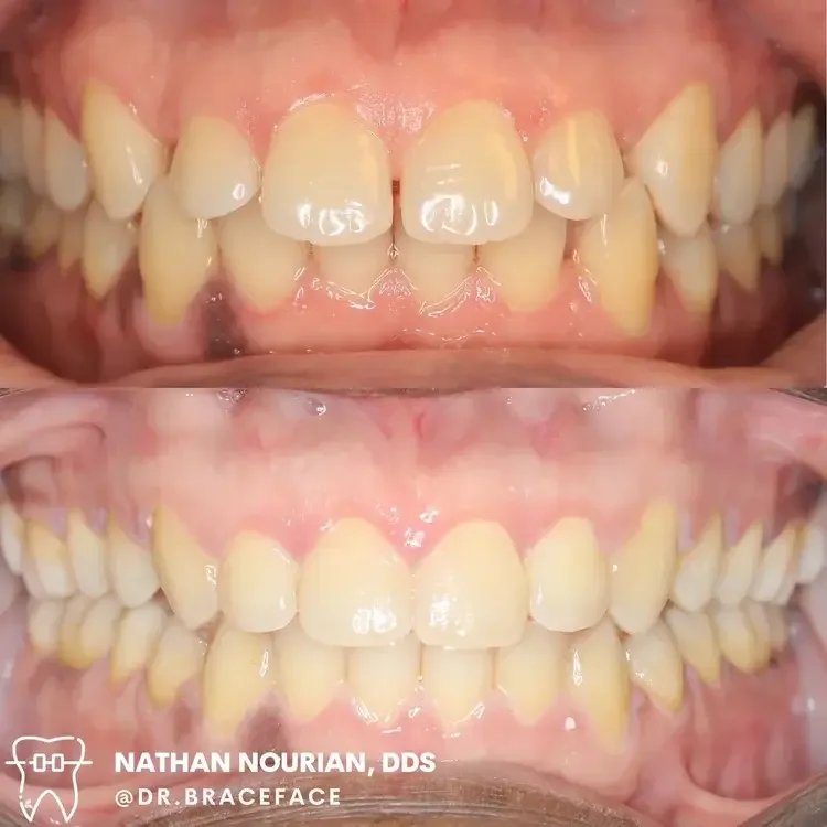 Before and after images of a person's teeth showing dental improvement, taken from above to highlight the upper and lower teeth.