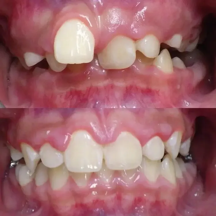 Close-up of a child's teeth before and after orthodontic treatment, showing improved alignment and spacing.