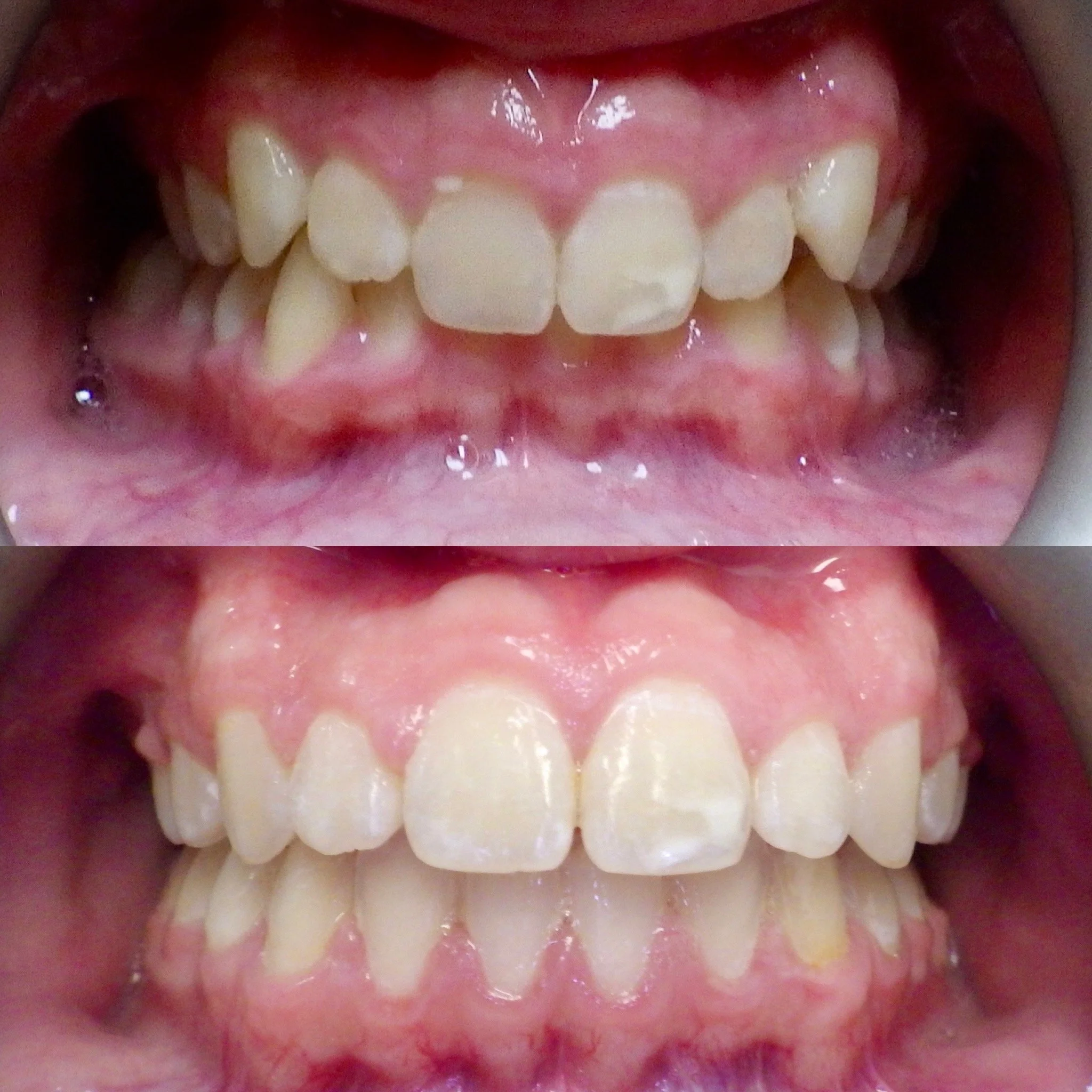 overbite correction with braces