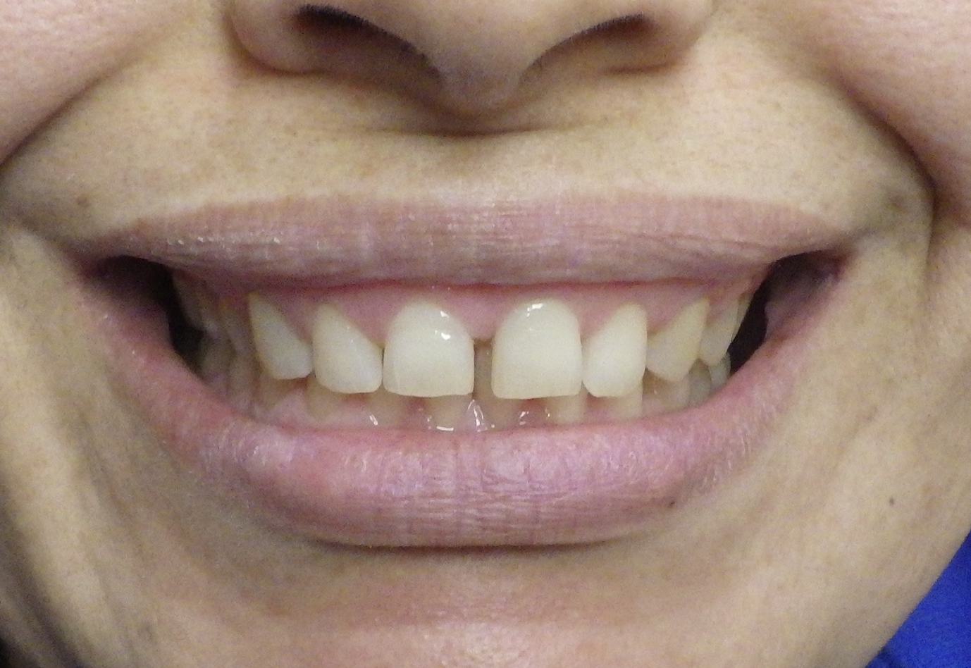 tratamiento de la sonrisa gingival en Los Ángeles
