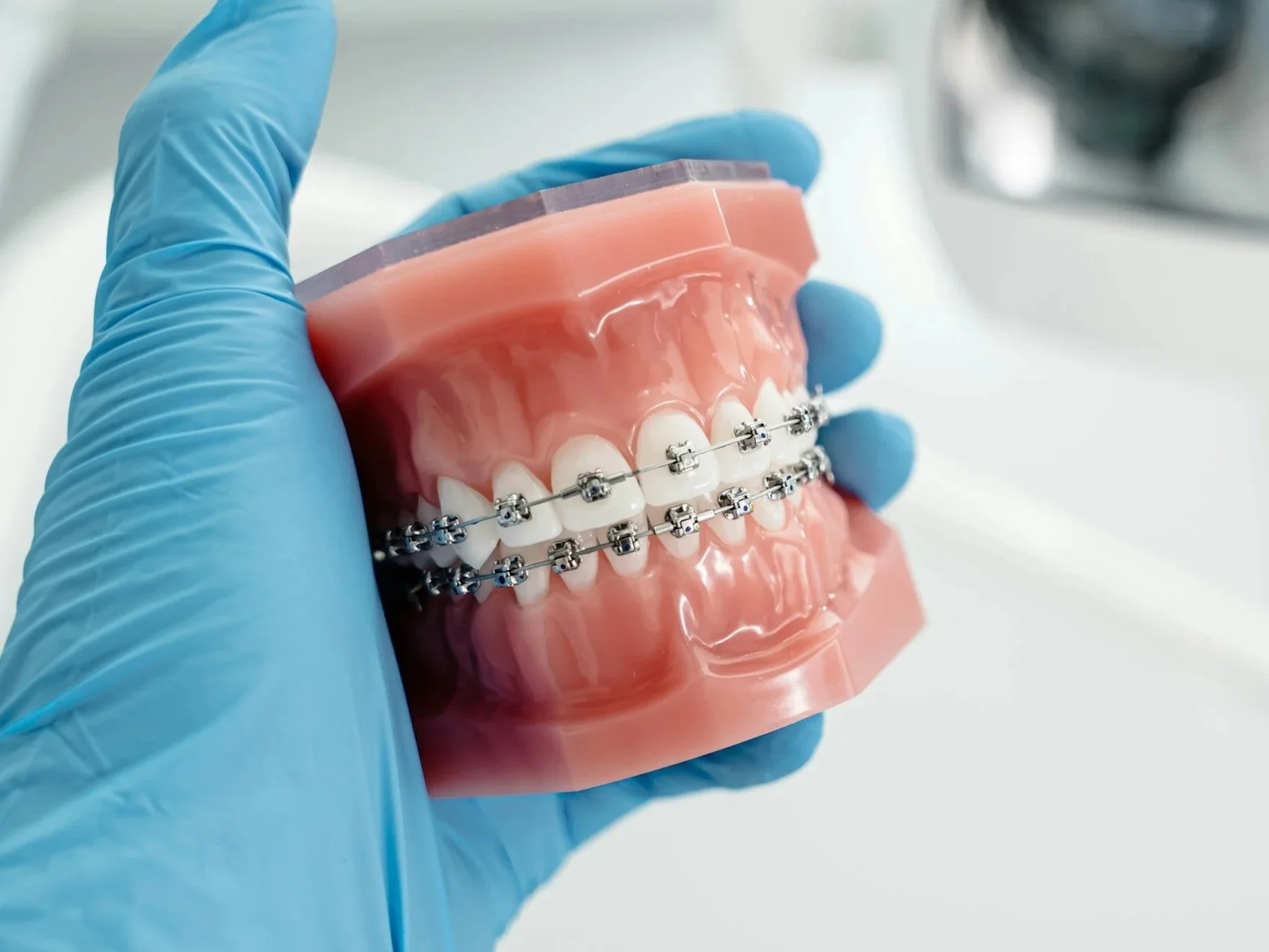 BRACES in Granada hills