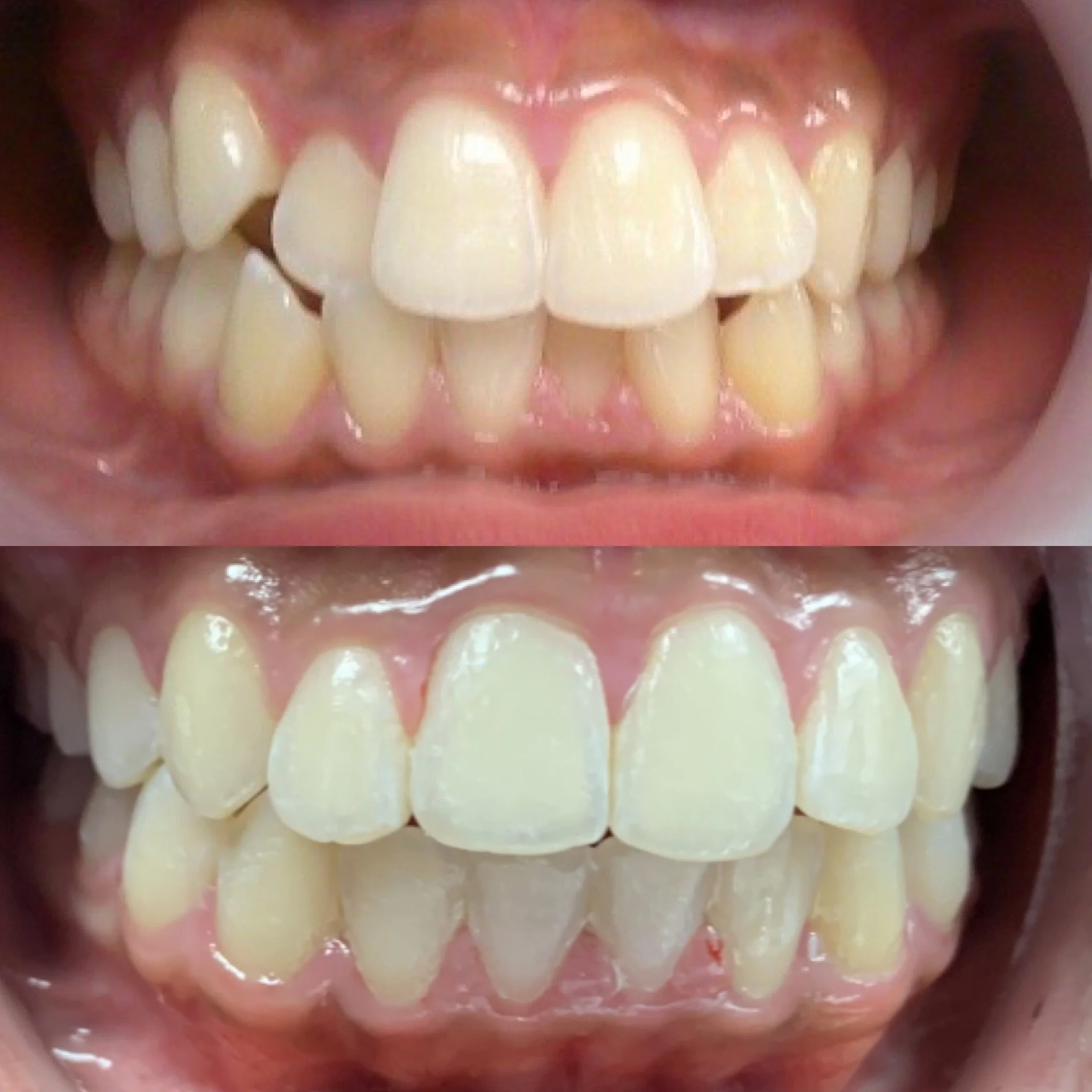 Comparison of teeth showing misalignment and after dental correction, with healthier appearance in the after photo.