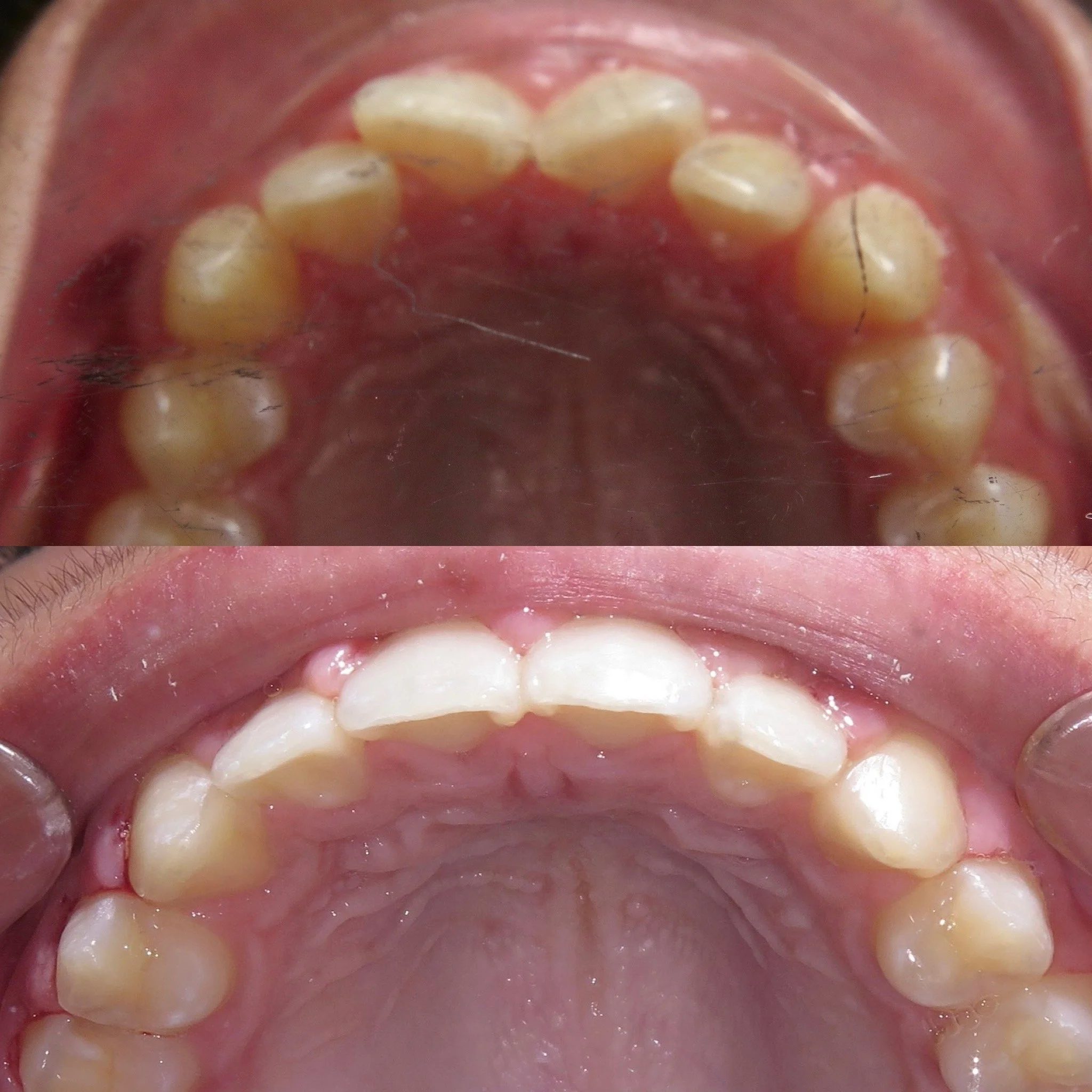 Close-up images of the upper teeth, showing before and after dental treatment.