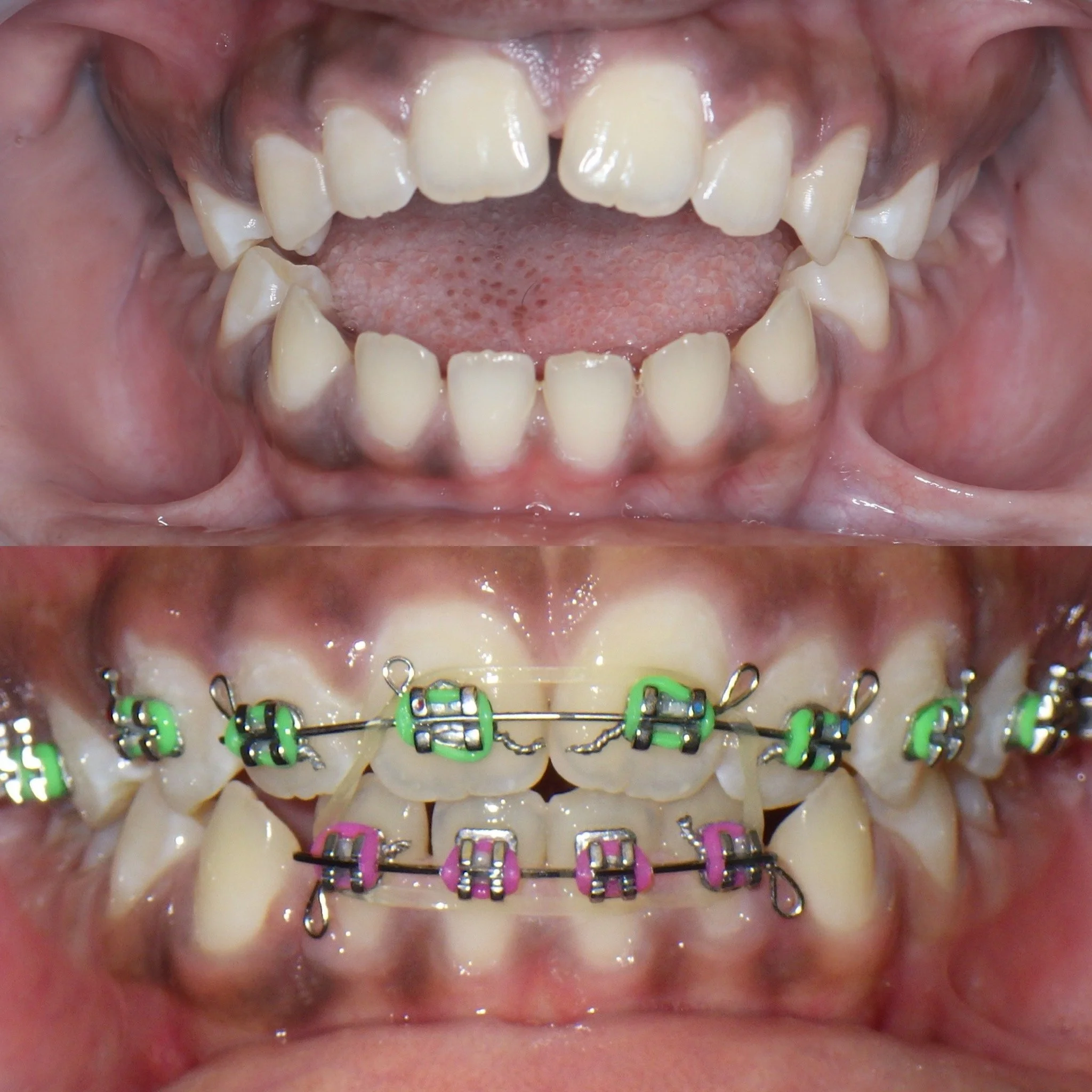 Tratamiento de la respiración bucal en Los Ángeles
