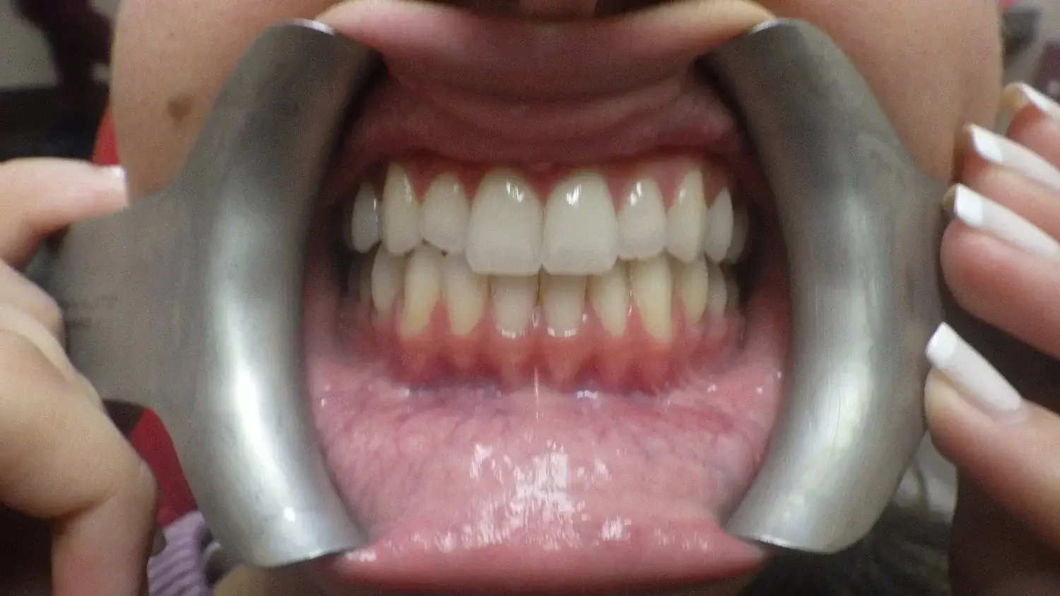 Close-up of a person's open mouth with a dental cheek retractor showing teeth and gums.