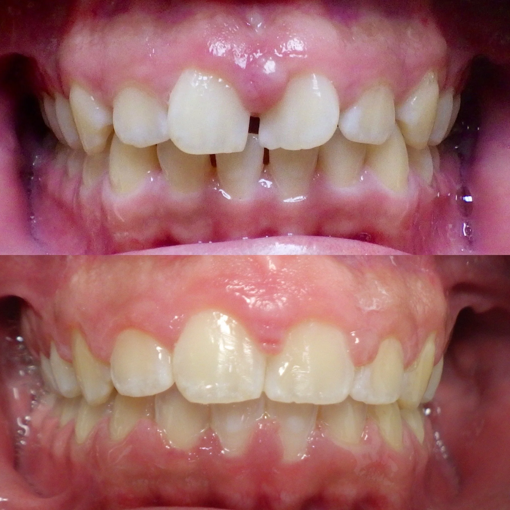 closing gaps in teeth with braces