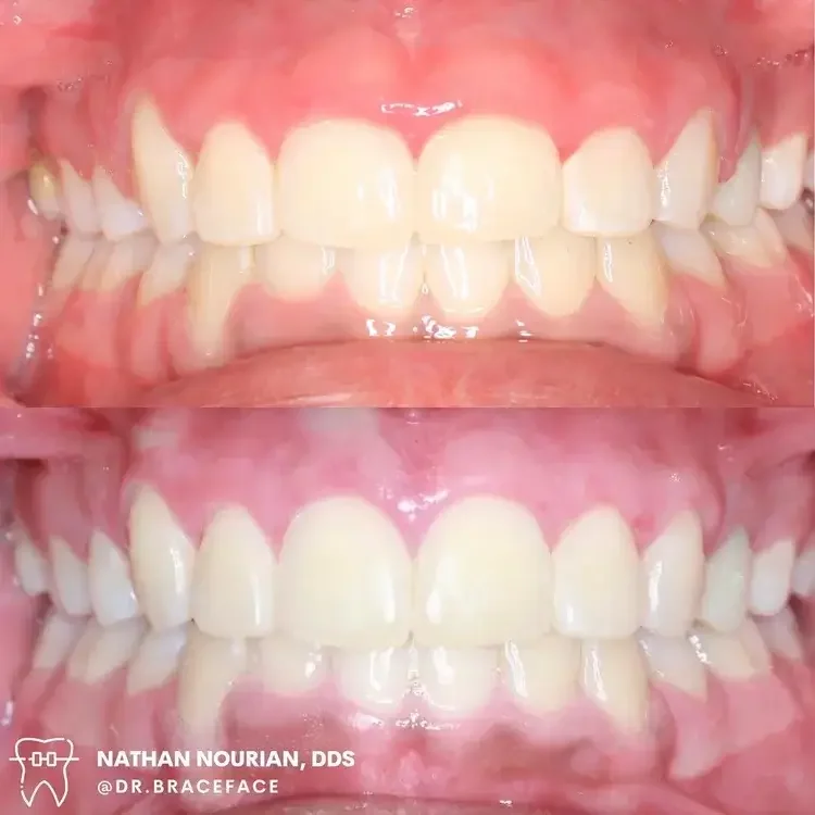 Comparison of teeth before and after dental treatment showing improved alignment and whitening.