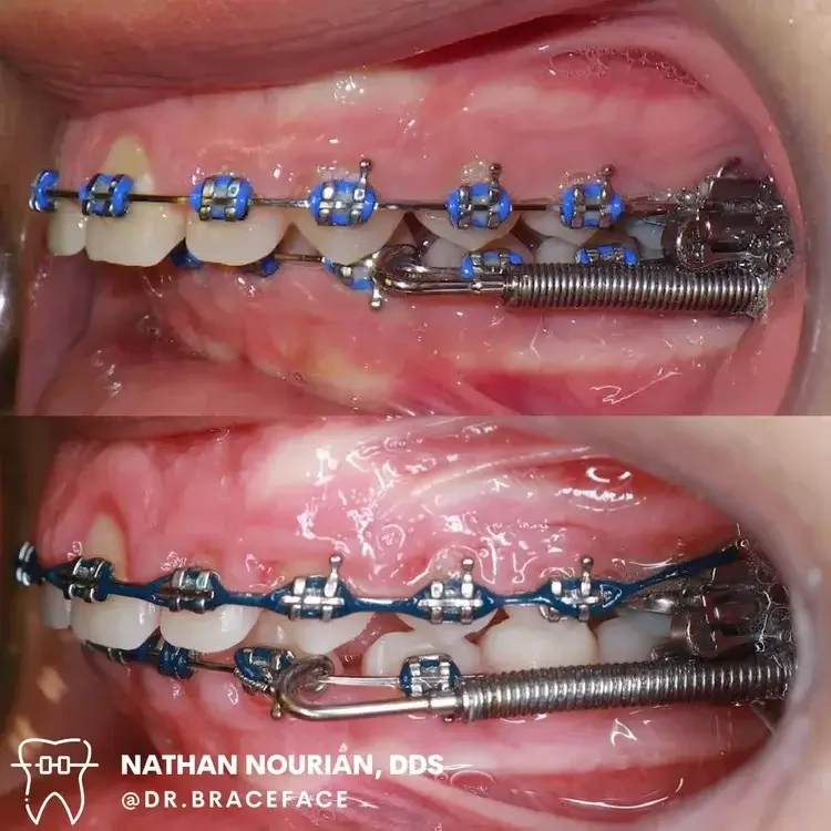Close-up of a patient's mouth showing dental braces before and after adjustment, with metal brackets, wires, and orthodontic spring.