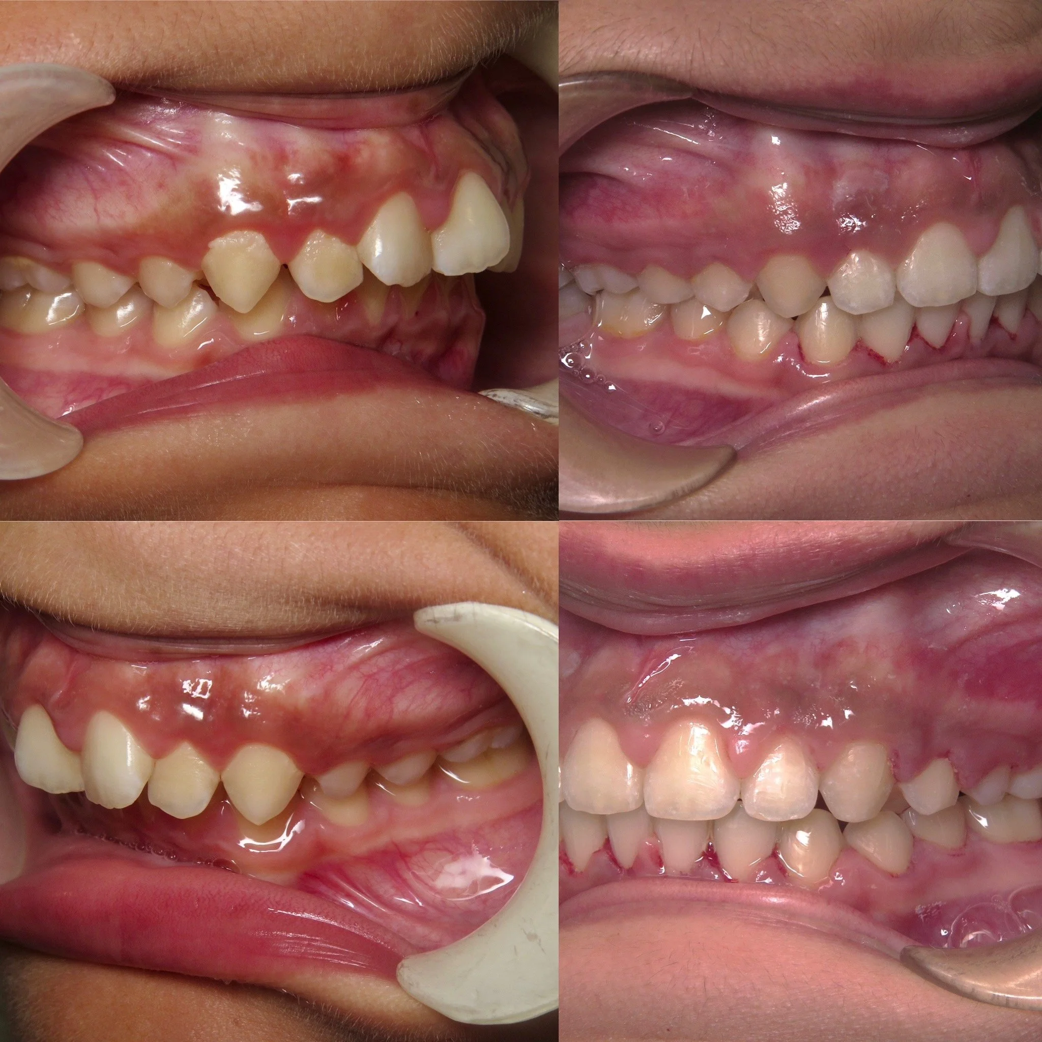 Comparison of four close-up views of a child's upper and lower teeth, showing dental crowding and overlapping.