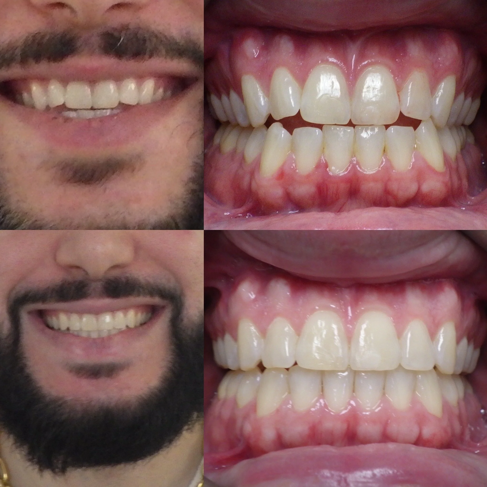 correcting open bite with clear aligners