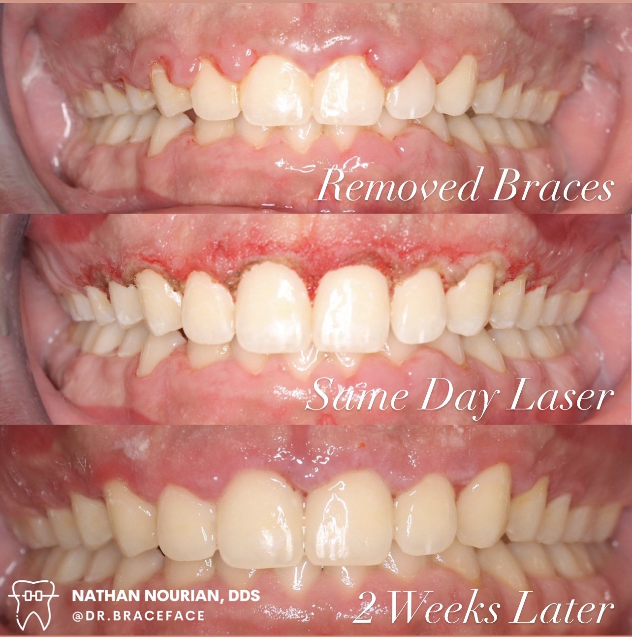 before and after laser gum removal for gummy smile