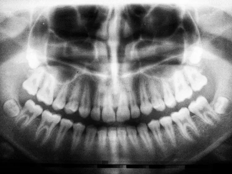 X-ray image of a person's teeth and jaw.