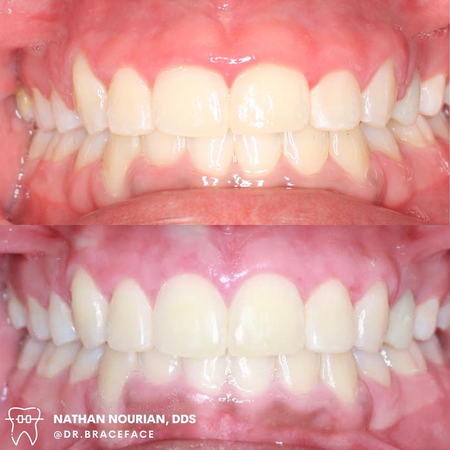 Laser gum contouring on front 6 teeth
