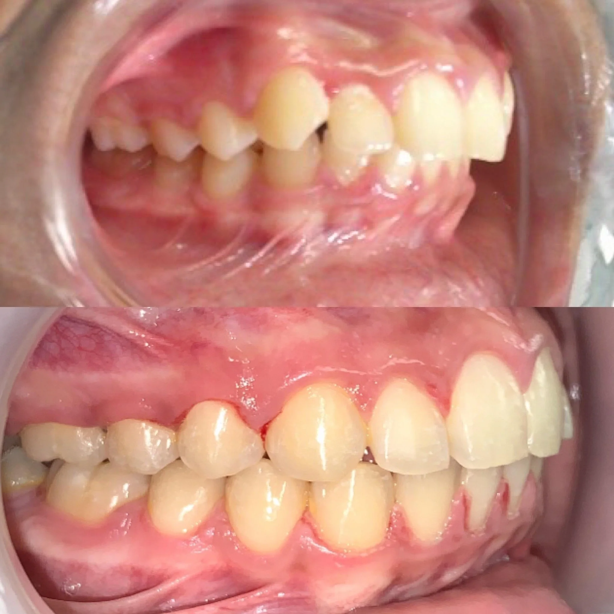 Comparison of teeth before and after orthodontic treatment, showing improved alignment of upper and lower teeth.