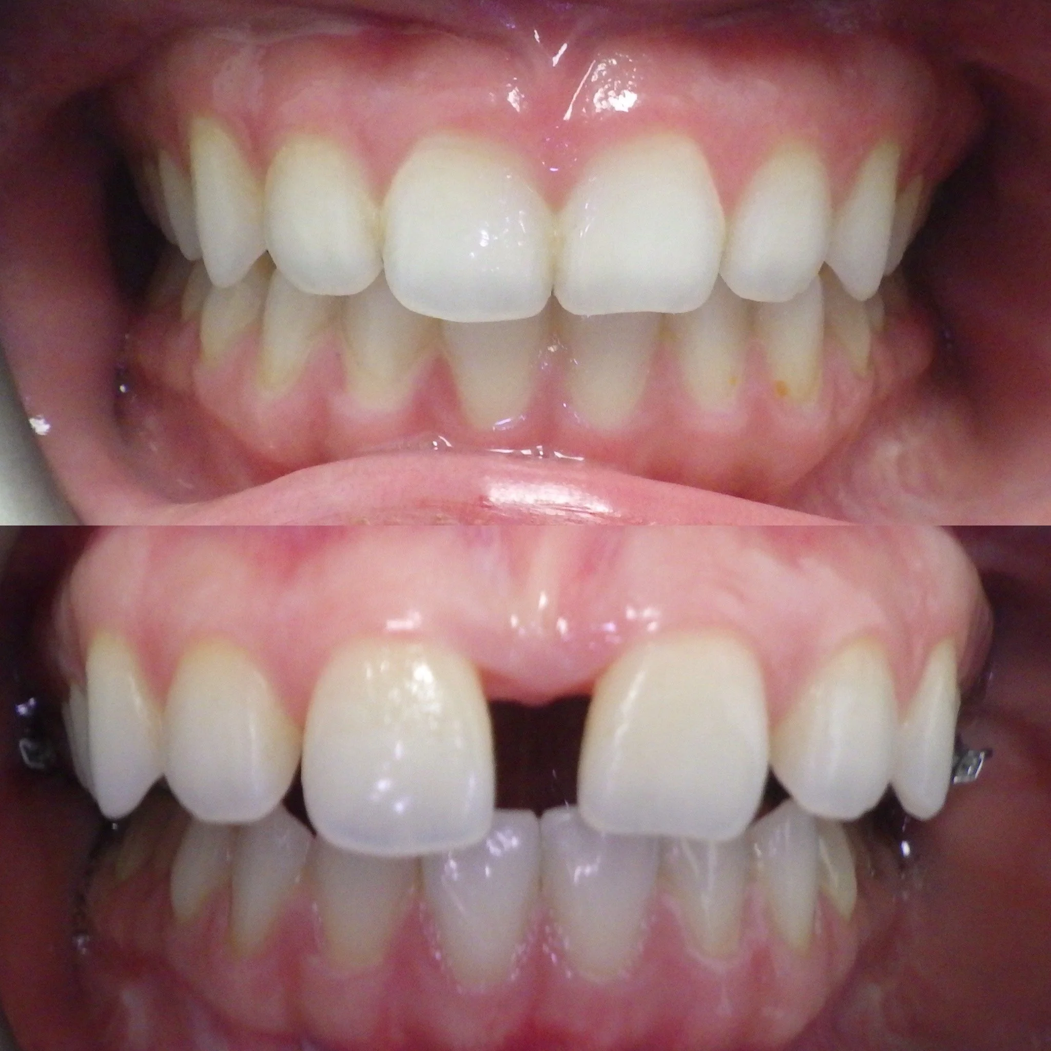 Marpe diastema split