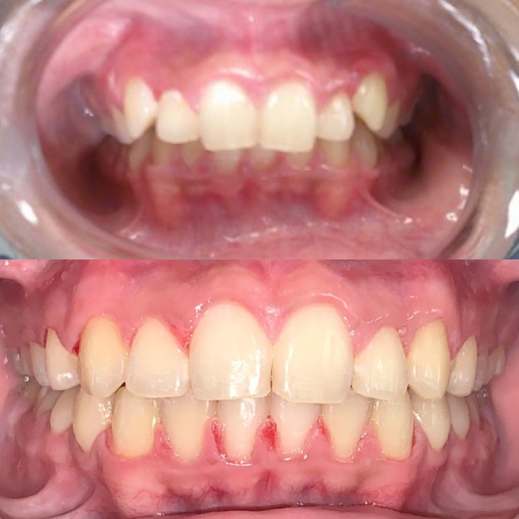 Comparison of teeth before and after dental treatment, showing improved alignment and gum health.