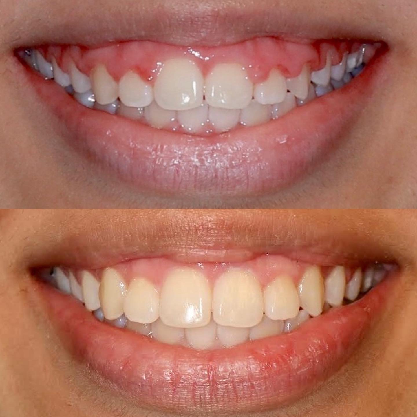 Laser gum removal to increase tooth size creating a more balanced smile